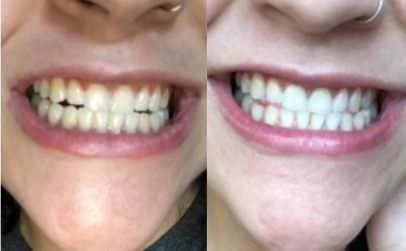 Crest Whitening Emulsions Before After 2